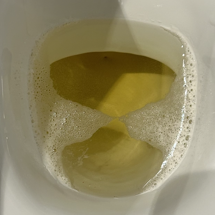 Frothy urine